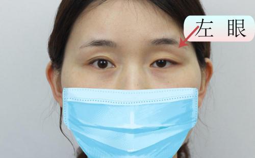 眼瞼下垂大約多少錢(4個月前做了左眼上瞼下垂修復(fù)和雙眼凹陷填充)