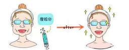 瘦脸针怎么打多少钱（瘦脸针你该这样打）