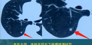 粘液腺癌能活多少年（这个肺结节）
