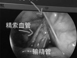 做睾丸手术要多少钱（2岁宝宝先天睾丸）