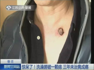 色素痣如何去除多少钱（女子点痣半年后发生癌变）