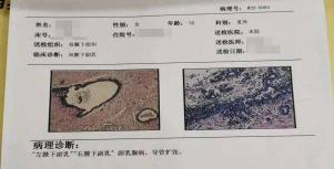 切除副乳一般多少钱（吊带衫）