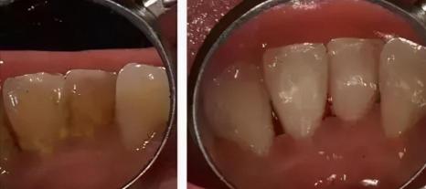 洗牙多少钱一次 能洗白吗（洗牙疼不疼）