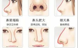 鼻部整形整容术多少钱（科普）