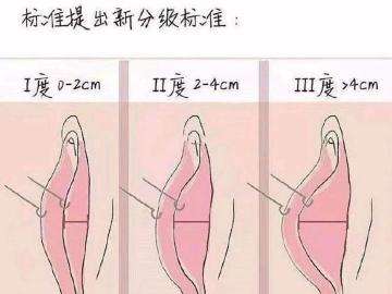 成都小阴唇手术多少钱（你真的有必要进行小阴唇整形吗）