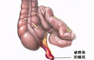 阑尾炎腹腔镜手术多少钱（阑尾炎手术治疗）