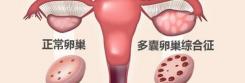 睾丸酮多少钱一盒（患多囊卵巢两年没有怀孕）
