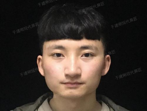 男士隆鼻多少钱永久的（男生隆鼻术后效果怎么样）