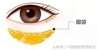 去眼袋要多少钱（备受追捧的微创内吸去眼袋）