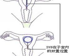 一般上环需要多少钱（一文说清楚）