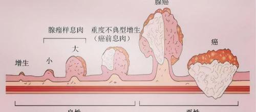 肠镜息肉切除多少钱（1厘米的肠息肉）
