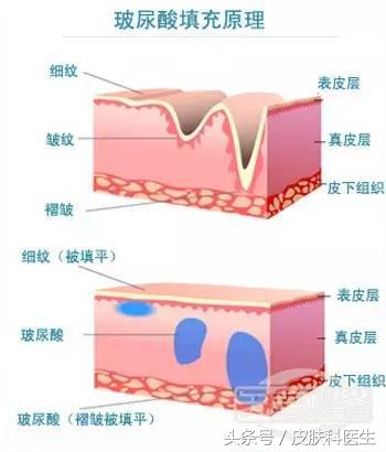 玻尿酸丰臀多少钱（微整形有三宝）