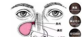鼻息肉手術需要多少錢（關于鼻息肉的治療步驟）