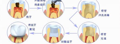 襄一颗烤瓷牙多少钱（烤瓷牙虽好）