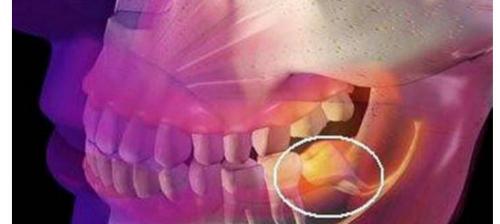 上海拔智齿多少钱一个（为什么要拔智齿）