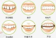 孩子箍牙要多少钱（儿童矫牙大概要多少钱）