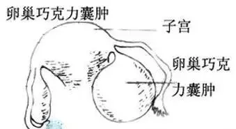 巧囊手术多少钱（手术都做干净了）