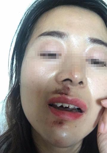 门牙修复多少钱（女子骑电动车过减速带摔破相）