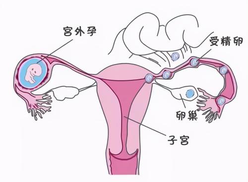 输卵管疏通术要多少钱（输卵管堵塞怎么治疗）