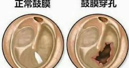 鼓膜修补术要多少钱（科普）