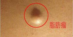 皮下脂肪瘤手术多少钱（脂肪瘤是怎么引起的）