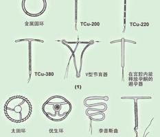 带环大约多少钱（关于节育环那些事）