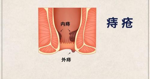 做痔疮手术需要多少钱（痔疮手术哪种最彻底）