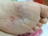 脚气一次净多少钱一盒（痒）