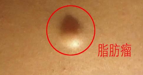 脂肪瘤开刀多少钱（什么是脂肪瘤）