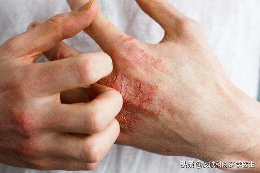 肤疾洗剂多少钱（3类外治湿疹的中成药汇总）
