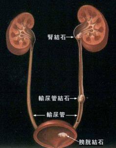 体外震波碎石多少钱（有一种病平时不疼）