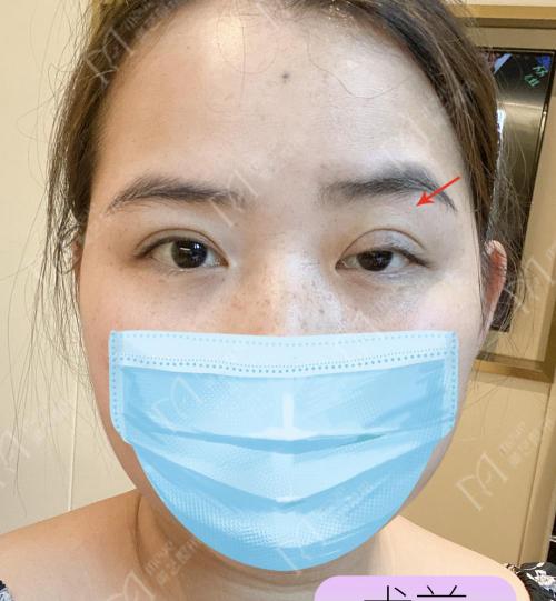 大小眼矫正多少钱（西安小姑娘5个月前找我们修复了大小眼的问题）