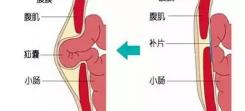 小肠换气手术多少钱（肚子痛）