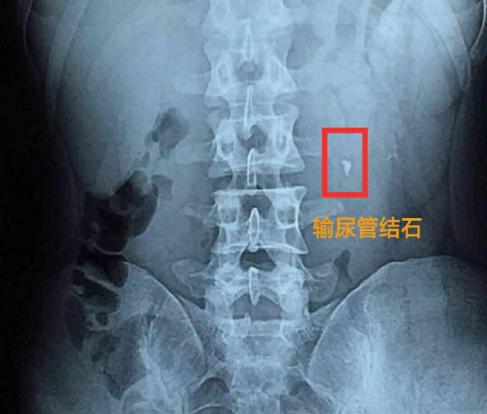 尿路结石治疗多少钱(尿路结石不一定非要手术)
