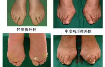 拇外翻手术需要多少钱（这位患者拇外翻拖了20年）