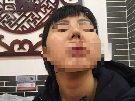 检查鼻子要多少钱（女子花1万7隆鼻）