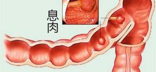 切除肠息肉多少钱（医生提醒）