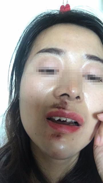 补门牙多少钱（女子骑电动车过减速带摔破相）