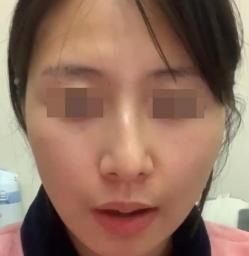 矫正鼻子多少钱（歪斜的鼻子应该如何矫正治疗）