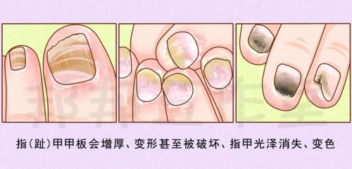 氟康唑软膏多少钱一盒（灰指甲可以用什么外用药）