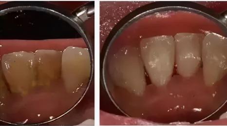 洗个牙多少钱（洗牙疼不疼）