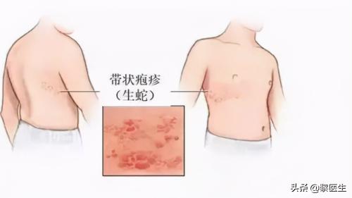 转移因子胶囊多少钱（缠腰蛇带状疱疹表面治疗了）