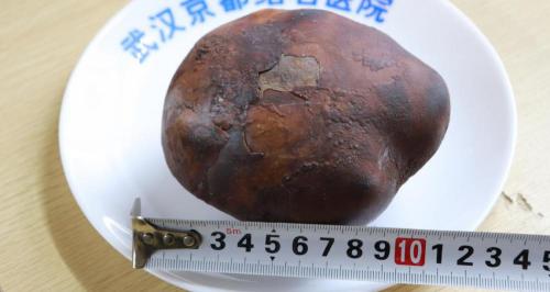 膀胱结石手术多少钱（鸵鸟蛋一样大的膀胱结石见过吗）