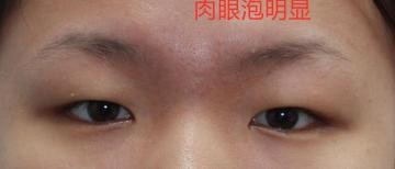 去除肿眼泡手术多少钱（一位网友咨询）