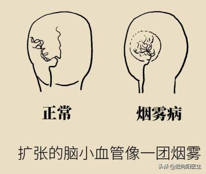 烟雾头一年多少钱（烟雾病是个什么病）