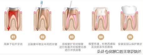 做根管治疗要多少钱（为啥根管治疗这么贵）
