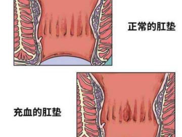 做一次痔疮手术多少钱（不同的痔疮都是怎么治疗的呢）