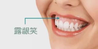 上海矫正牙齿多少钱（上海牙齿矫正）