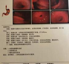 食管裂孔疝手术多少钱（食管裂孔疝造成的胸闷咳嗽）