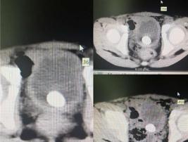 膀胱结石手术多少钱（男童膀胱结石反复尿频尿痛还血尿）